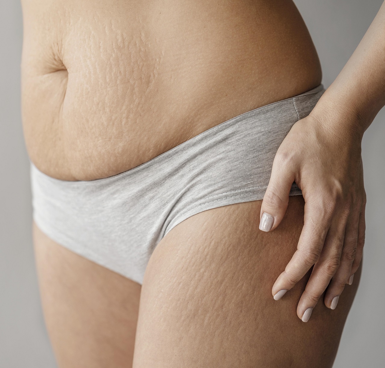 7 Things You Need to Know About Treating Stretch Marks